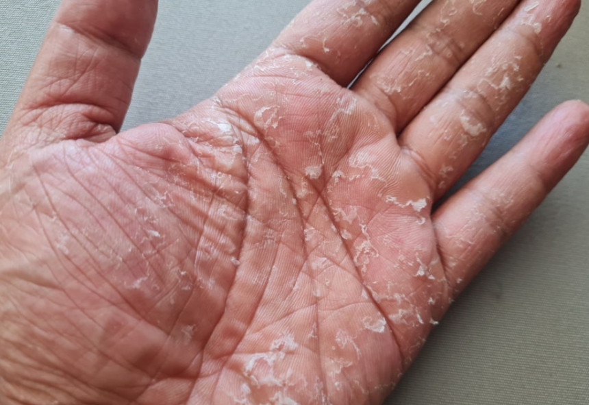 주부습진의 모습