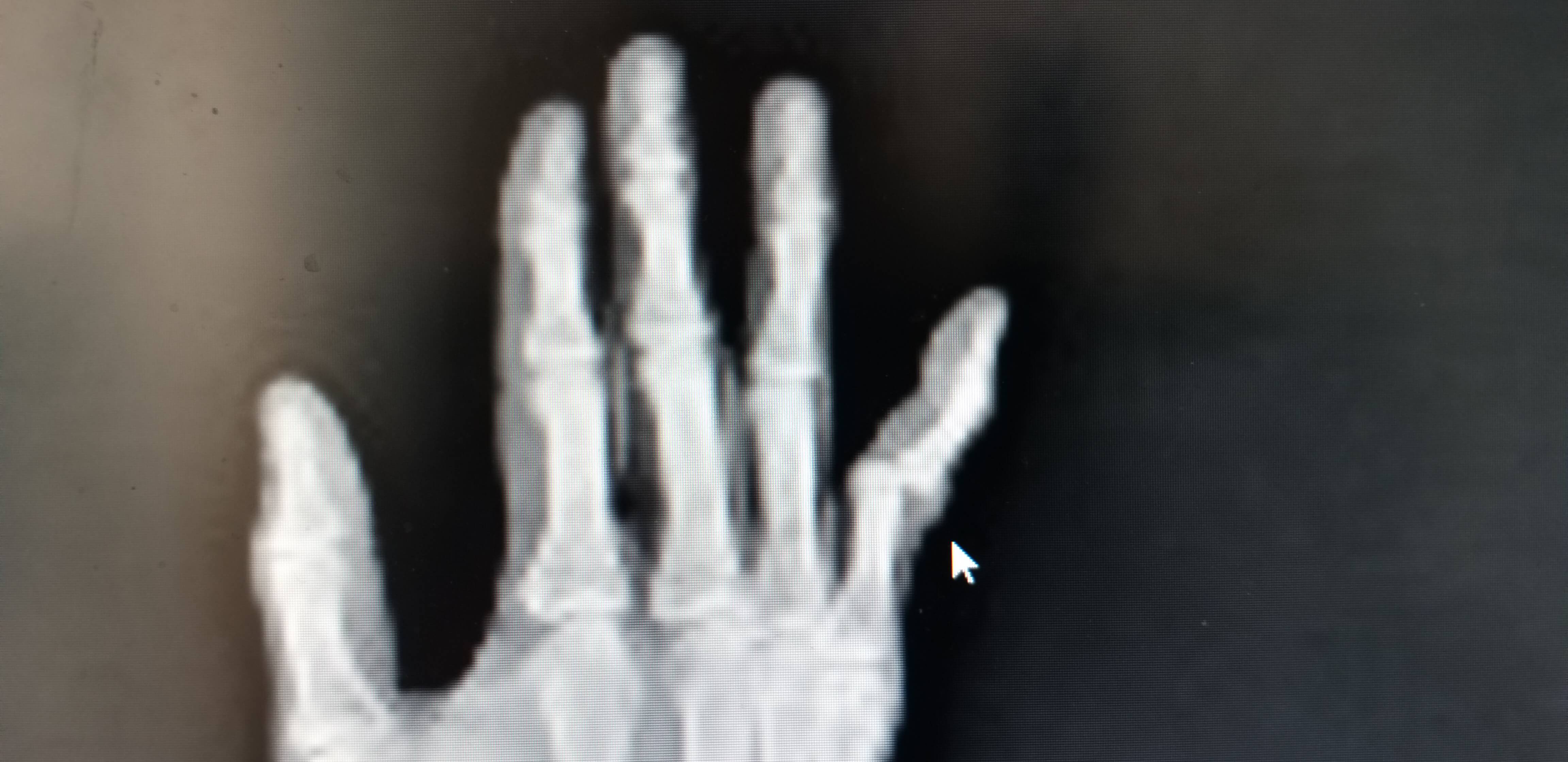 손가락인대파열사진2