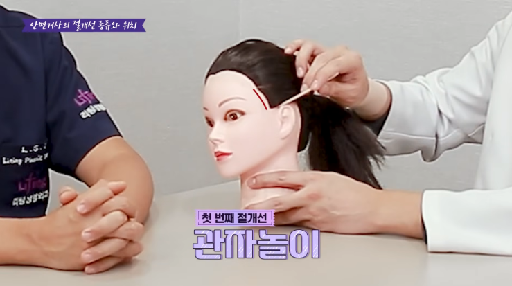 신사역성형외과 안면거상흉터 관자놀이 절개