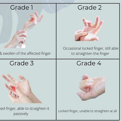방아쇠-수지-증후군 -설명