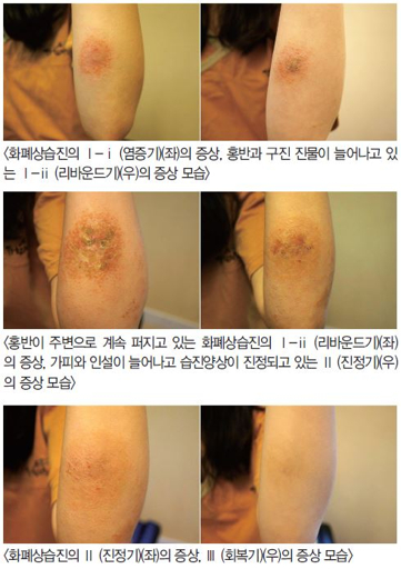 습진 가려움 집에서 응급 처치하는 방법