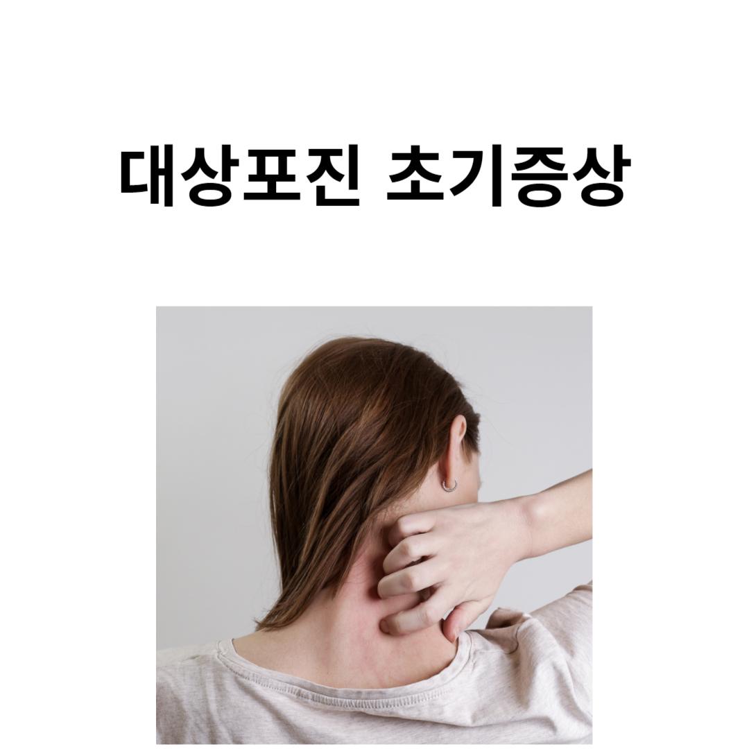 대상포진 초기증상
