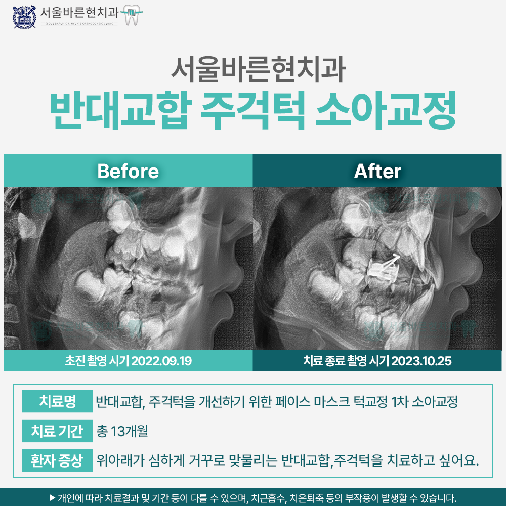 마린시티소아교정