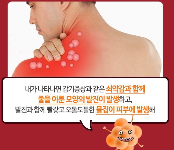 대상포진 초기증상과 치료법 총정리!