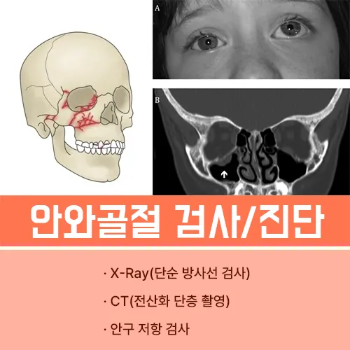 안와골절 검사