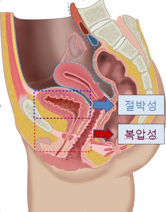 요실금 치료방법