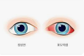 포도막염의 예방 및 치료 방법