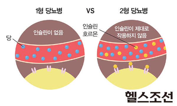 1형 당뇨병과 2형 당뇨병