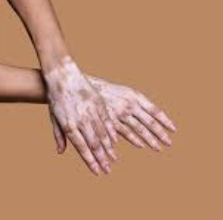 백반증 초기증상 30