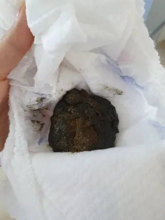 똥이 까만색 검정똥 원인과 질병 가능성_25