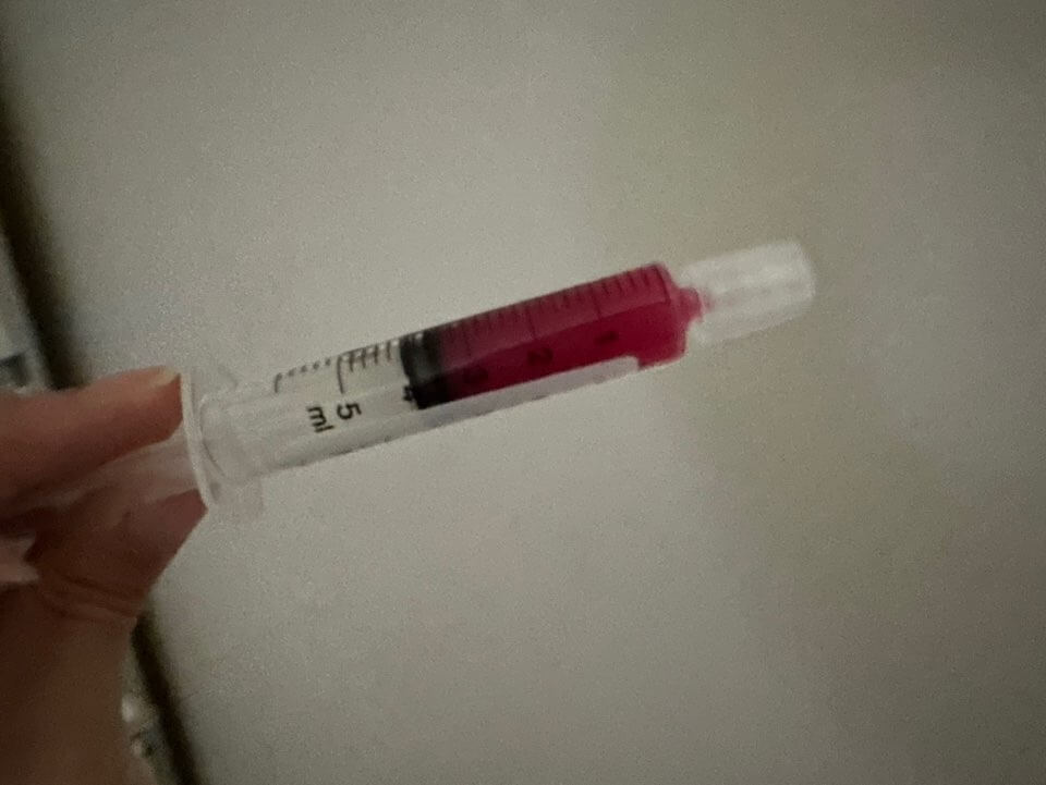 아기 요로감염 증상 및 입원기간