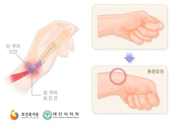 손목 통증&amp;#44; 손목 통증 원인&amp;#44; 손목 통증 치료방법&amp;#44; 손목 통증 병원&amp;#44; 손목 통증 완화운동&amp;#44; 손목 통증 약&amp;#44; 손목 손가락 통증&amp;#44; 손목 짚을때 통증&amp;#44; 손목 손등 통증&amp;#44; 테니스 손목 통증&amp;#44; 손목 통증 스트레칭&amp;#44; 손목 결절종 통증&amp;#44; 손목 터널 증후군&amp;#44; 손목 건초염&amp;#44; 손