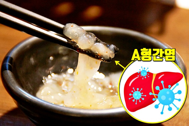 a형간염 증상 원인, 중국산 조개젓, 여름에 많이 걸리는 병, 건강 팁줌 매일꿀정보