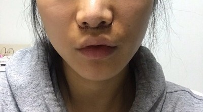 인중 축소 수술 후기