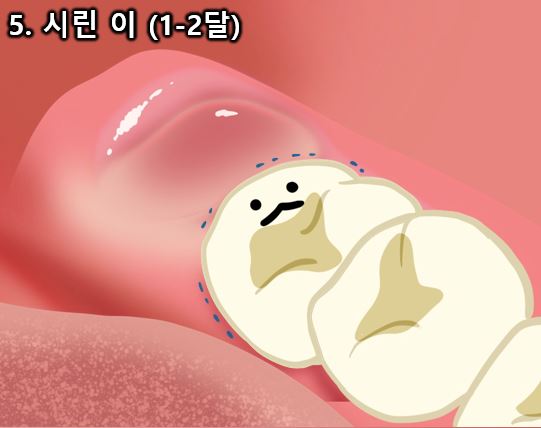 드라이 소켓, 사랑니 발치후 붓기 등 사랑니 발치 후 이상증상 완벽정리