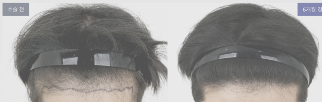 비절개식 이식술