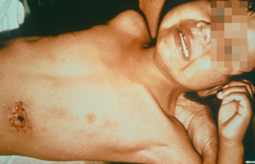 [법정 감염병] 페스트(흑사병) 증상 및 감염 경로, 예방 방법