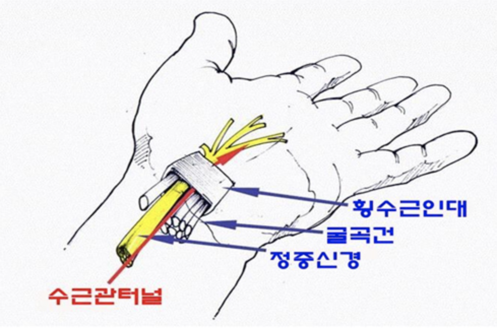 수근관증후군-터널증후군-손목통증