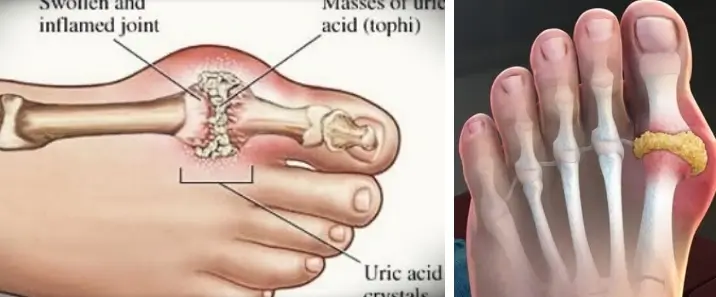 병원못가는상황 통풍 응급처치 방법 통풍발작 상비약