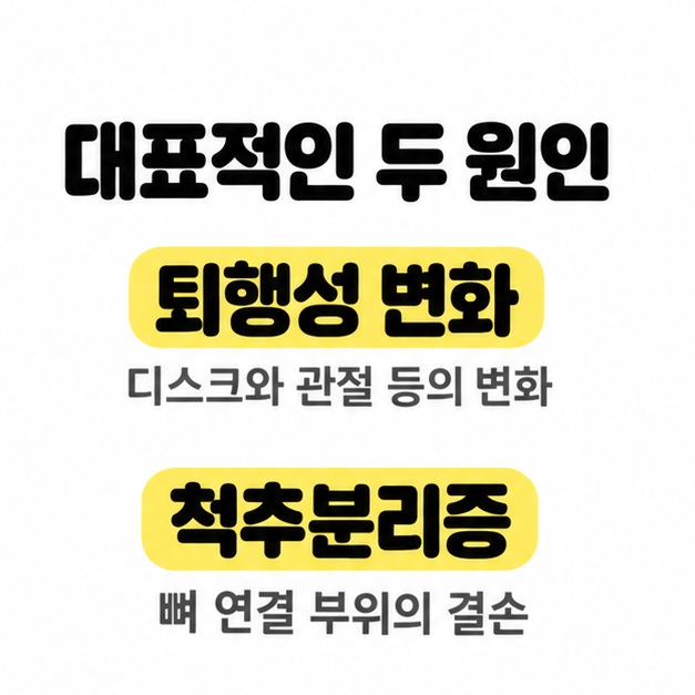 대표적인 두 원인으로 퇴행성 변화와 척추분리증을 나열하고 디스크와 관절 등의 변화 및 뼈 연결 부위의 결손을 설명한 카드