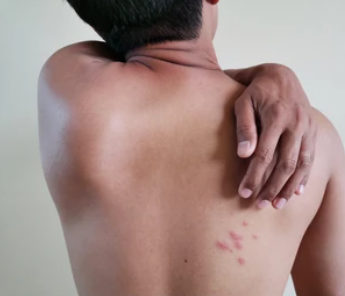 대상포진 초기증상