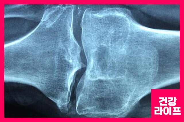 무릎 통증 치료 방법