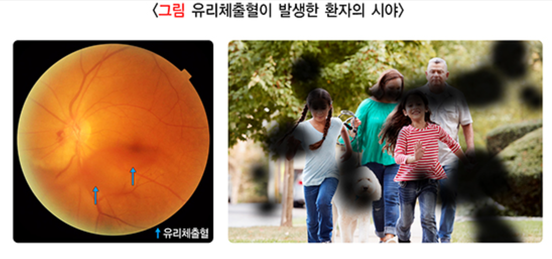 유리체출혈 이미지