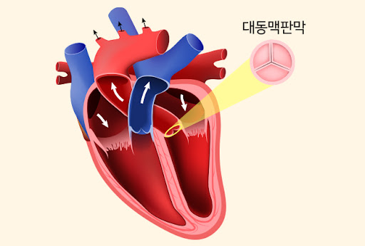 대동맥판막 협착증