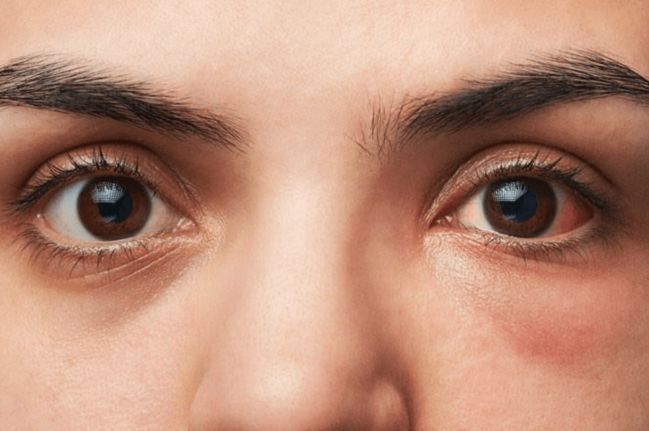 눈안에-이물질이-충혈