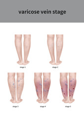 클리펠 트라우네이 베버 증후군