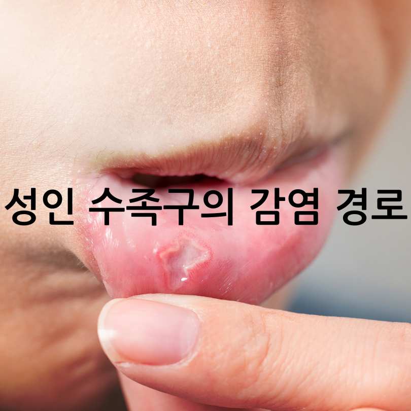 성인수족구 감염&#44; 증상&#44;원인&#44; 경험담까지