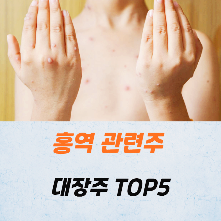 홍역 관련주 대장주 테마주 수혜주 TOP5