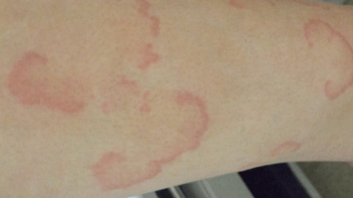 알레르기성 두드러기의 원인과 치료법