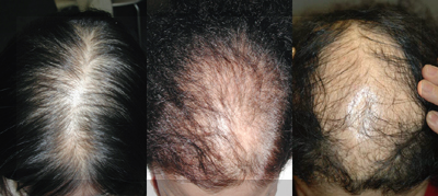 로게인폼-가격-로게인폼-부작용