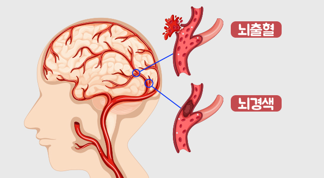 뇌졸중 전조 증상