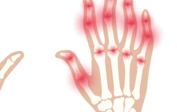 류마티스 관절염 치료법