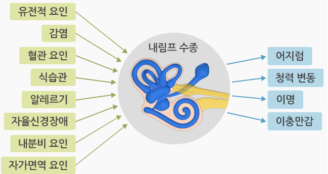 메니에르병 원인