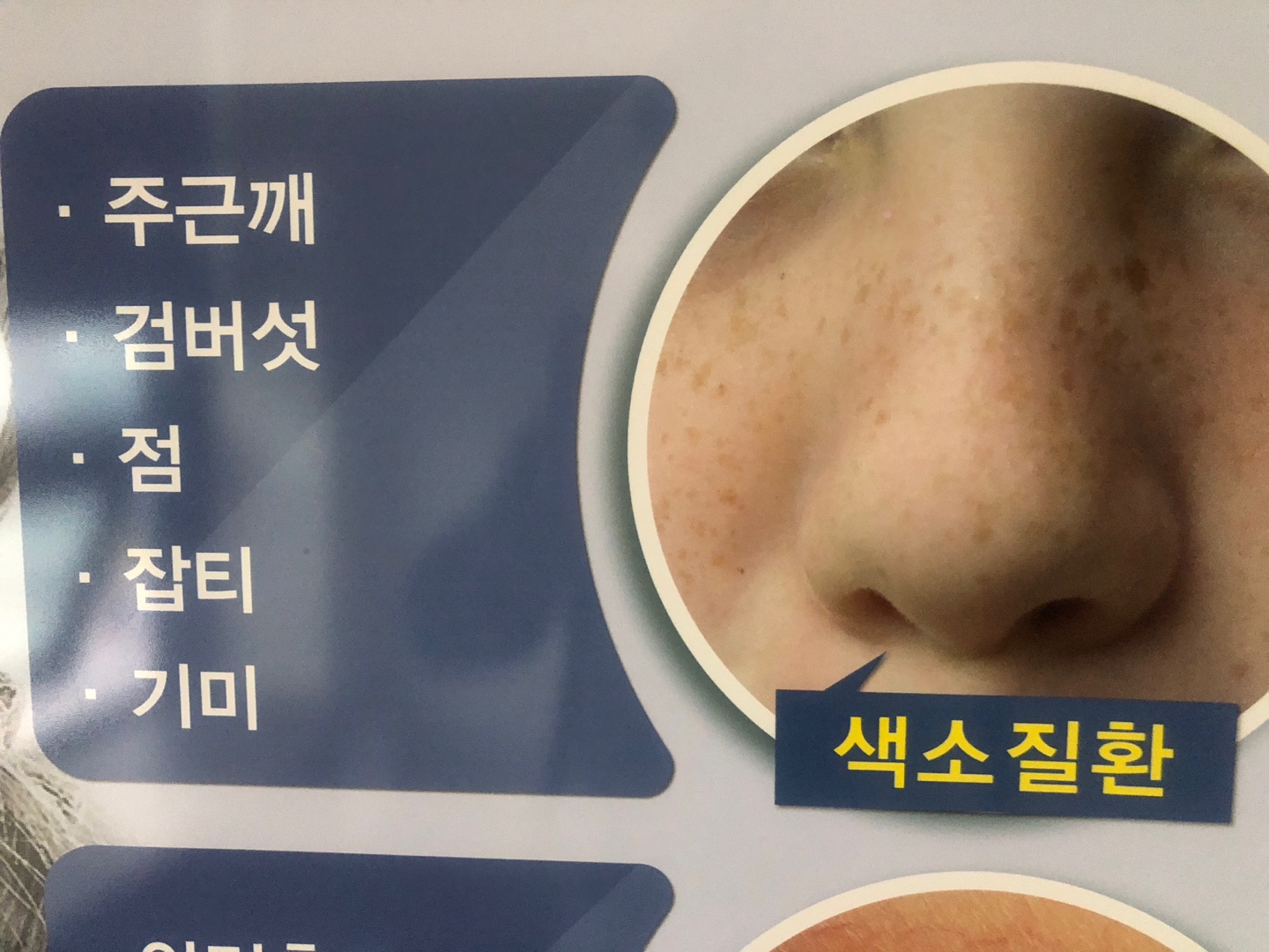 검버섯-치료 과목