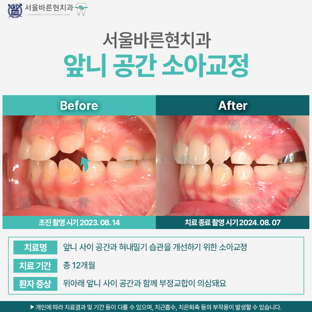 부산마린시티소아교정