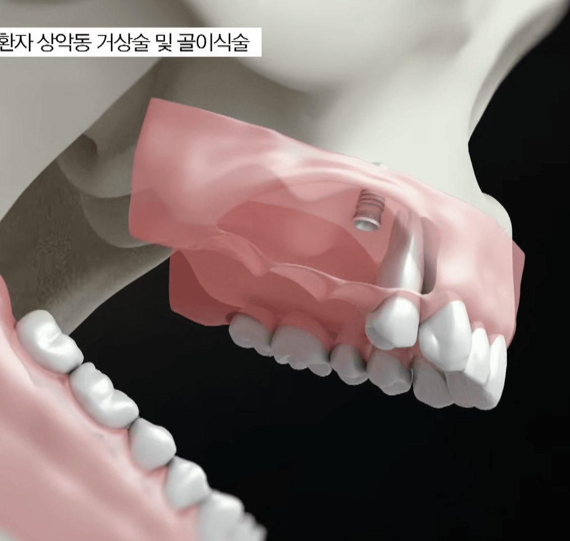 임플란트 골이식술