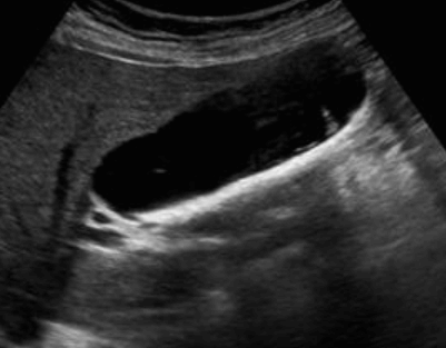 담석증 (Cholelitiasis = GB stone)