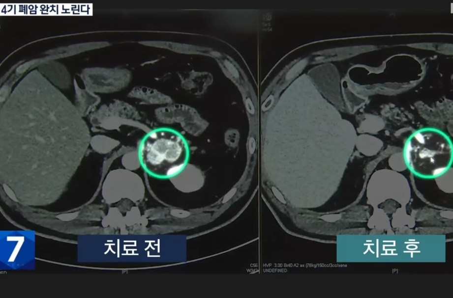4기폐암완치