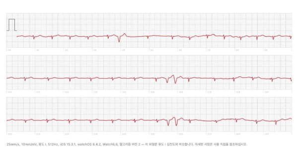 부정맥
