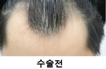 모발이식전