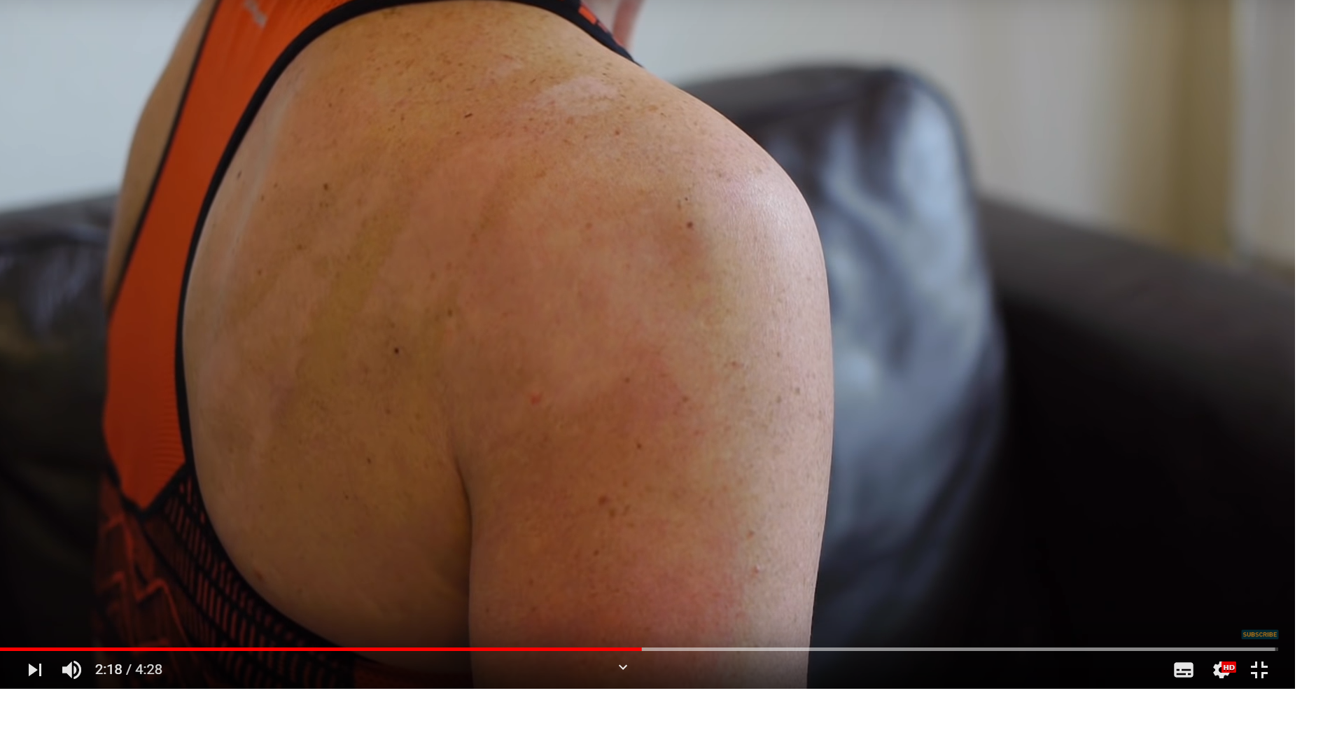 윔호프호흡법효과-화상치료-후