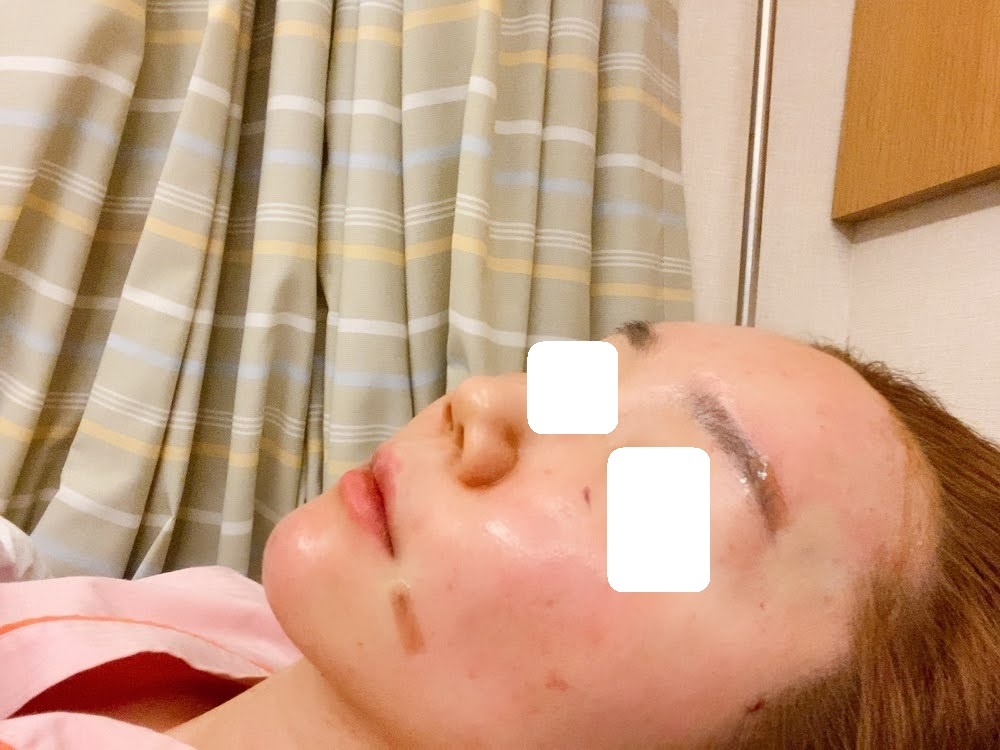 얼굴지방이식후기