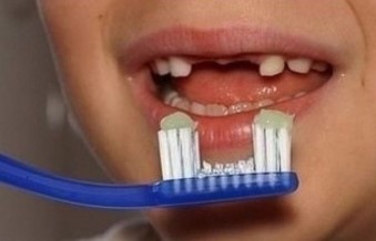 윗이빨-3개가-빠져-칫솔도-가운데를-자르고-치약을-묻혀-양치하는-어린이