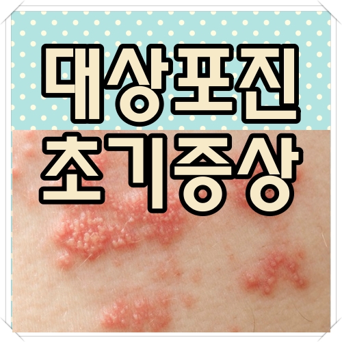 대상포진 초기증상