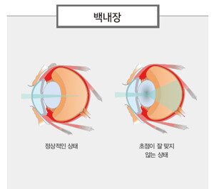 백내장 (2)