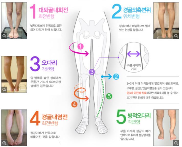 오다리를 만드는 역학을 나타내는 그림 대퇴골과 경골이 내회전이 발생하면서 무릎사이가 벌어지는 그림.